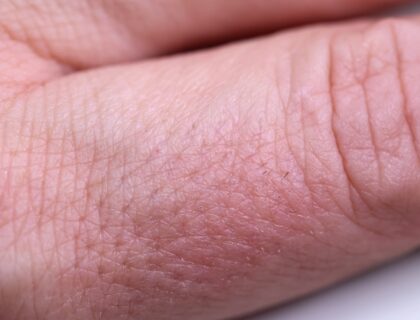 Wybite palce – objawy, leczenie i wskazania jak postępować w przypadku urazów sportowych